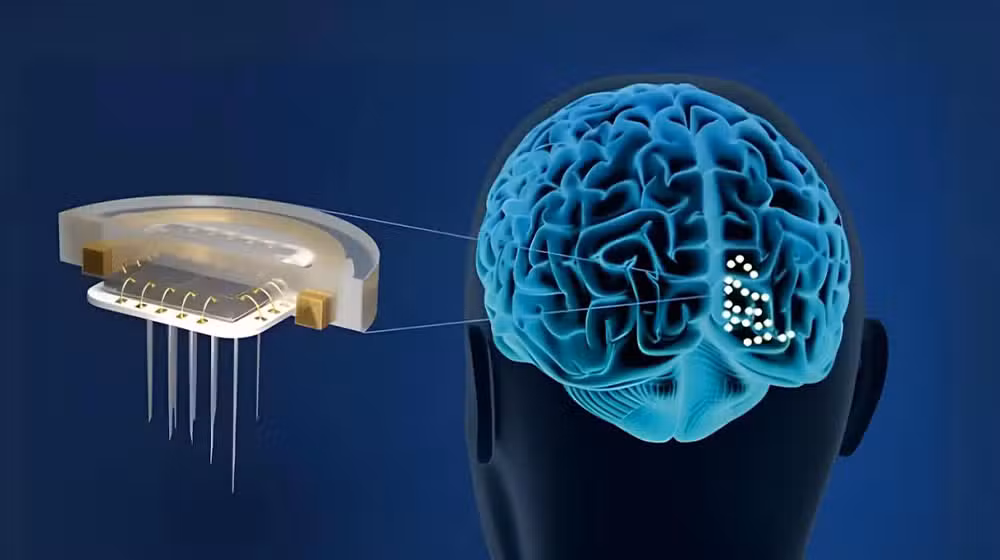 China Approves First Market-Ready Brain Implant to Cure Paralysis, Neck Injuries