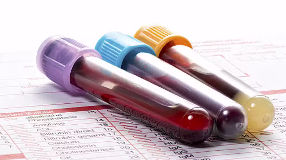 blood test mandatory for Nikkah