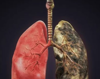 lung cancer drug trial